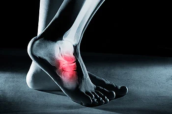 Running Injuries – How Common Are They?